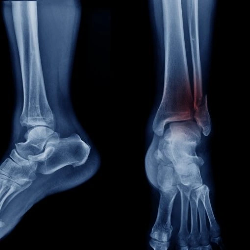 Ankle Fractures
